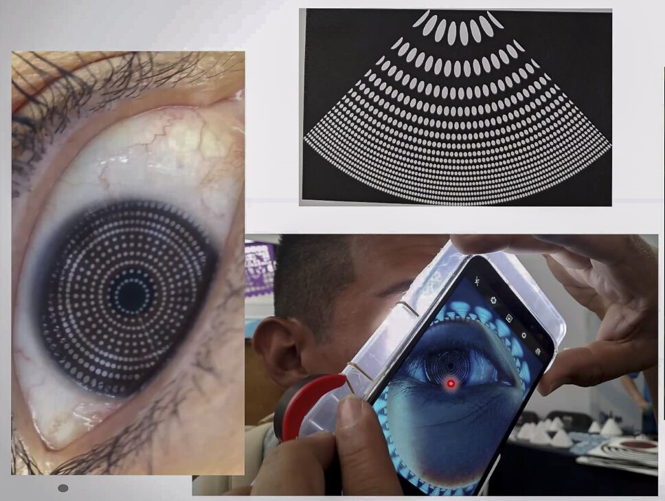 Smartphones para detectar enfermedades cerebrales