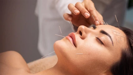 Beneficios de la acupuntura para tener una vida saludable