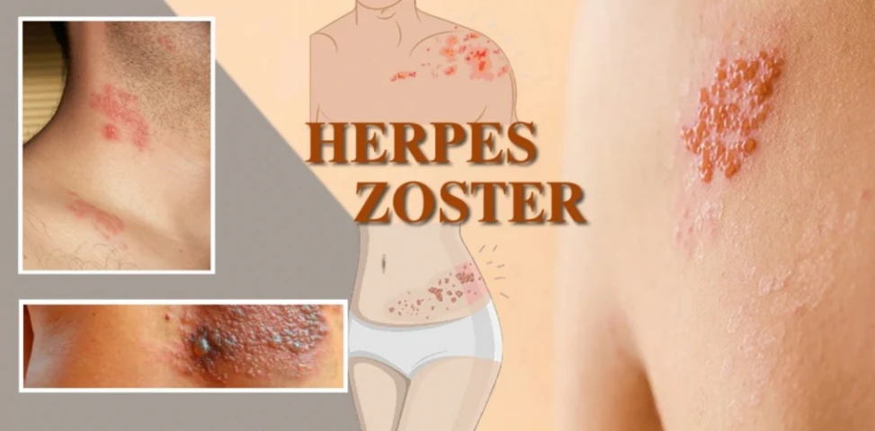 El herpes zoster conocido como culebrilla