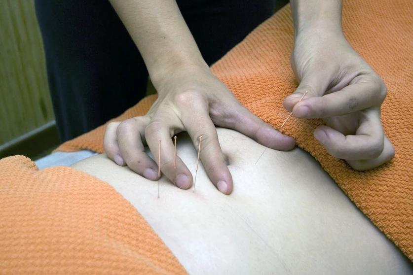 Acupuntura Acupuntura